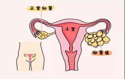 卵巢癌,卵巢癌特征