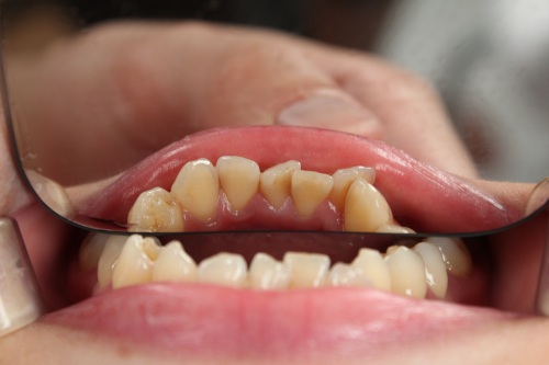 中医怎么治疗牙龈萎缩？这几个妙方不妨试试