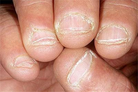 灰指甲症状