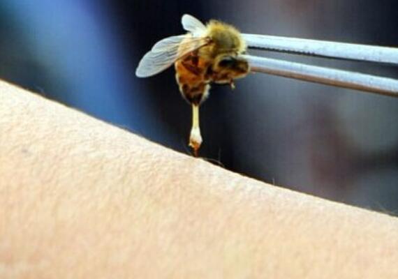蜜蜂蛰了怎么消肿止痛 蜜蜂蛰消肿的最快方法